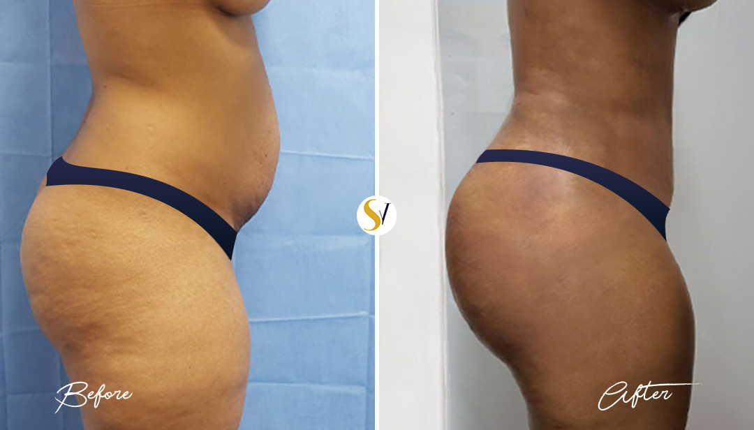 Brazilian Butt Lift Before and After
