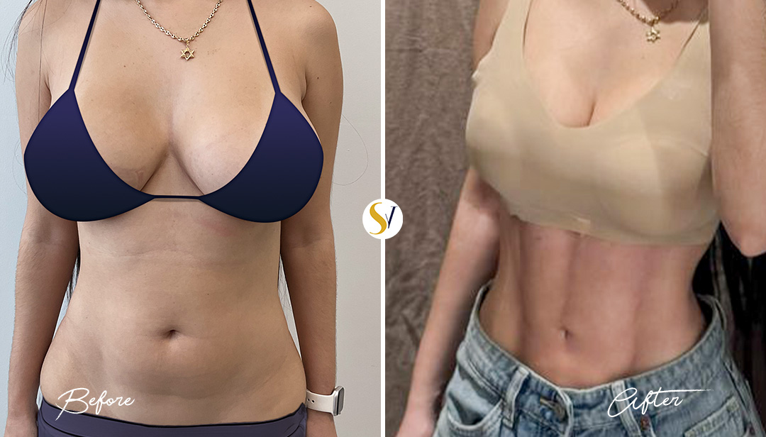HD Liposuction Before and After