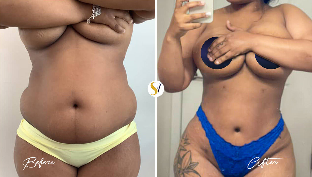 Lipo 360 Before and After