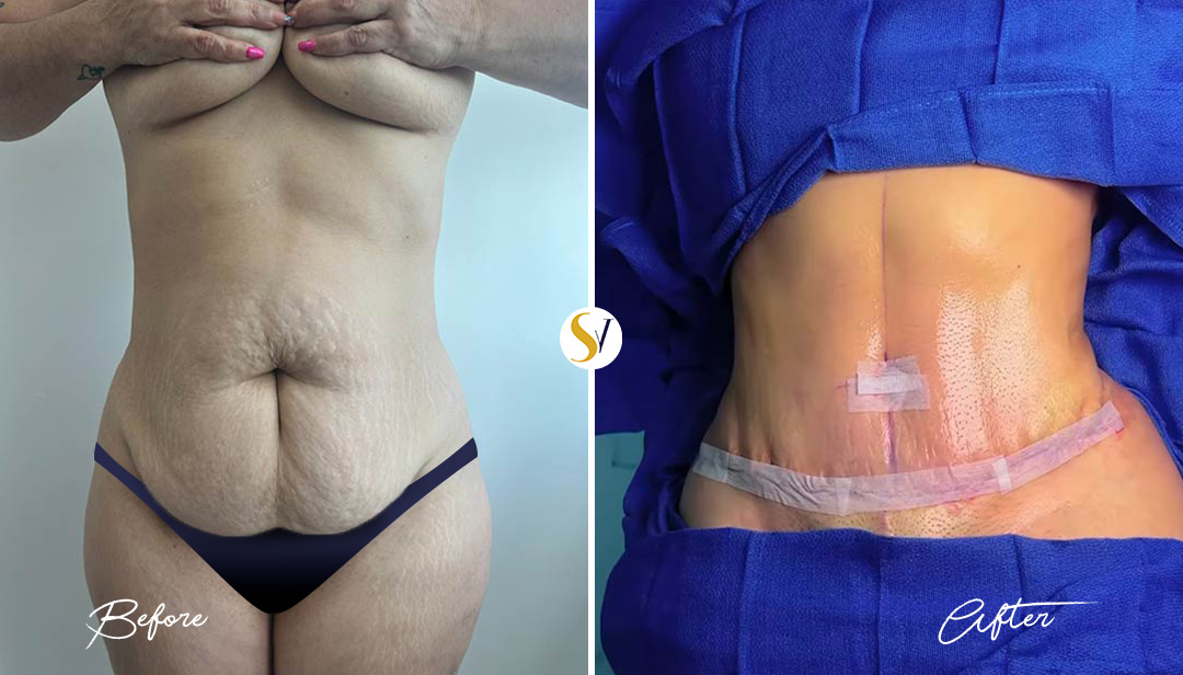 Tummy Tuck Before and After